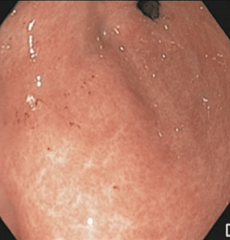 Эрозии желудка: геморрагические эрозии (III тип). Атлас эндоскопических изображений endoatlas